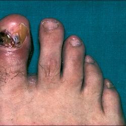 Example of skinCancerAndMelanomas